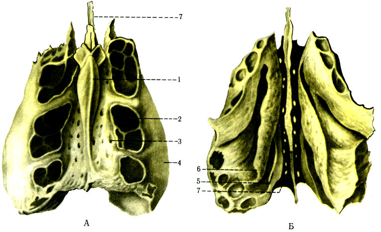 49.  .  -  ;  -  : 1 - crista galli; 2 - labyrinthitis ethmoidalis; 3 - lamina cribrosa; 4 - lamina orbitalis; 5 - concha nasalis superior; 6 - concha nasalis media; 7 - lamina perpendicularis