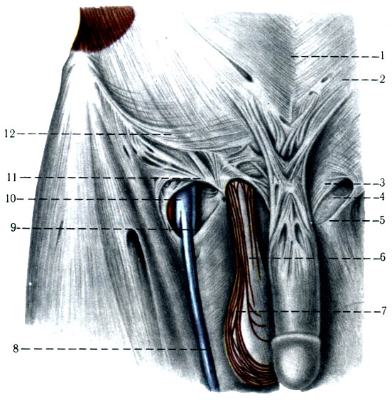 171.          . 1 - tinea alba; 2 - m. obliquus abdominis externus; 3 - crus mediale; 4 - lig. reflexum; 5 - crus laterale; 6 - funiculus spermaticus; 7 - m. cremaster; 8 - v. saphena magna; 9 - cornu inferius (margo falciformis); 10 - v. femoralis; 11 - margo falciformis (cornu superius)