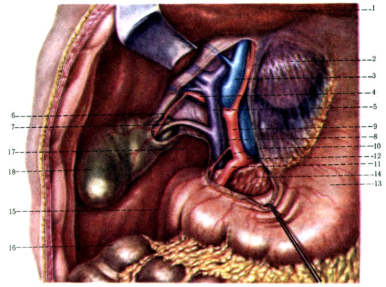 243.  - . 1 - hepar; 2 - omentum minus; 3 - v. portae; 4 - r. dexter a. hepaticae propriae; 5 - ductus hepaticus; 6 - a. cystica; 7 - ductus cysticus; 8 - ductus choledochus; 9 - a. hepatica propria; 10 - a. gastica dextra; 11 - a. gastroduodenalis; 12 - a. hepatica communis; 13 - ventriculus; 14 - pancreas; 15 - duodenum; 16 - colon transversum; 17 -   for. epiploicum; 18 - vesica fellea