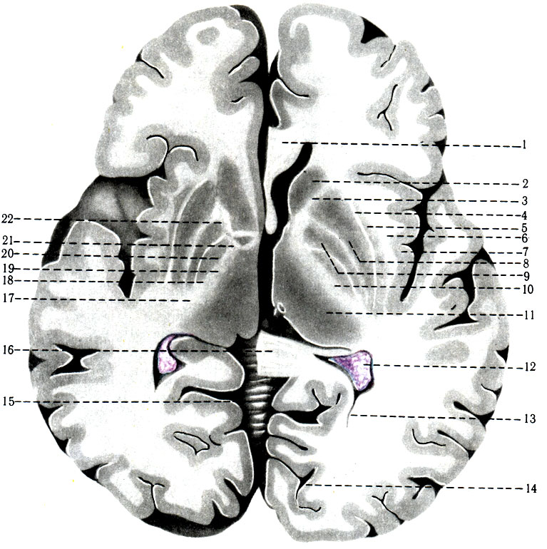 476.    . 1 - genu corporis callosi; 2 - caput n. caudati; 3 - crus anterius capsulae internae; 4 - capsula externa; 5 - claustrum; 6 - capsula extrema; 7 - insula; 8 - putamen; 9 - globus pallidus; 10 - crus posterius; 11 - thalamus; 12 - plexus chorioideus; 13 - cornu posterius ventriculi lateralis; 14 - sulcus calcarinus; 15 - vermis cerebelli; 16 - splenium corporis callosi; 17 - tr. n. cochlearis et optici: 18 - tr. occipitopontinus et temporopontinus; 19 - tr. thalamocortical; 20 - tr. corticospinalis; 21 - tr. corticonuclearis; 22 - tr. frontopontine