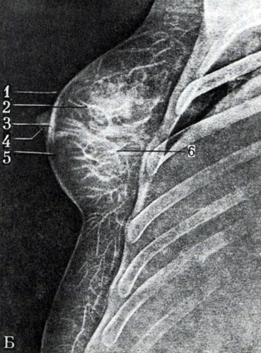 544.  ()      . : 1 - cutis; 2 - venae; 3 - areola mammae; 4 - papilla mammae; 5 - tela subcutanea; 6 - corpus mammae