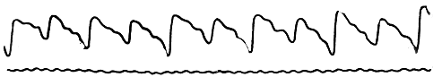 . 104. Pulsus alternans