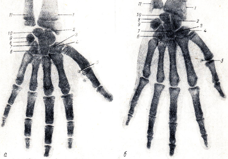 . 9.  .  -     (   I  );  -     (    I    ). 1 -   ; 2 -  ; 3 - os trapezoideum; 4 - os trapezium; 5 -    ; 6 -  ; 7 -  ; 8 -  ; 9 -  ; 10 -  ; 11 -   