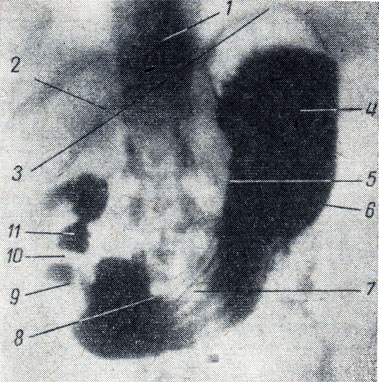 . 126.  . 1 - ; 2 - XII ; 3 -  ; 4 -  ; 5 -  ; 6 -  ; 7 -   ; 8 -  , 9 -    (sphincter antri); 10 -   - ; 11 - bulbus duodeni