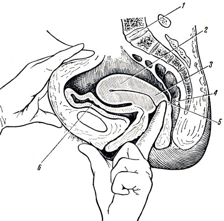 . 179.           (      ). 1 - promontorium; 2 - corpus uteri; 3 - cervix uteri; 4 - rectum; 5 - fornix vaginae; 6 - vesica urinaria