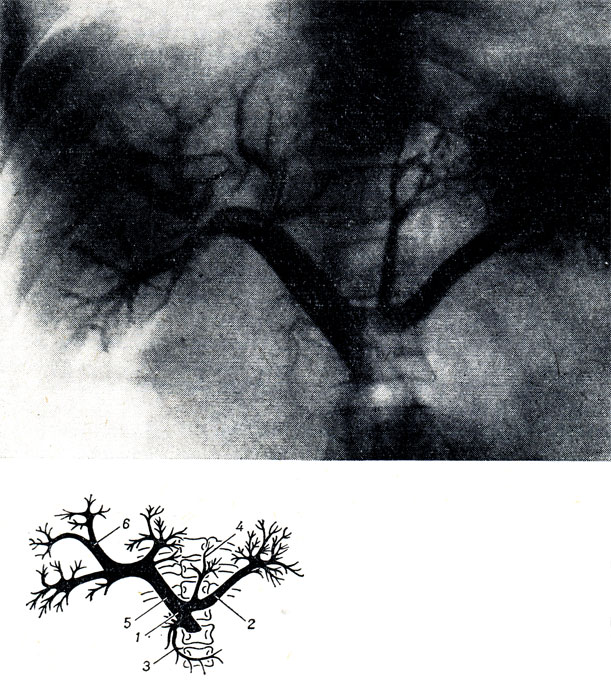 . 252.     ,     ,  ( . .   . . ). 1 - v. mesenterica superior; 2 - v. lienalis; 3 - v. pancreaticoduodenalis; 4 - v. gastrica sinistra; 5 - v. portae; 6 -  