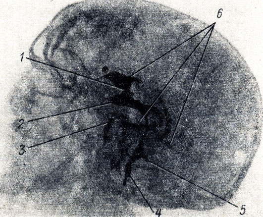 . 307.  . 1 - foramen interventriculare; 2 - infundibulum; 3, 4 -  ; 5 - ventriculus quartus; 6 - ventriculus lateralis (cornu anterius, cornu inferius, cornu posterius)