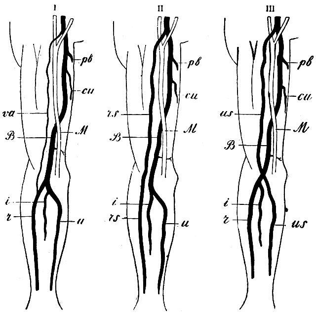 . 45. I -     .  -  a. brachialis; pb - a. profunda, brachii; cu - a. collateralis ulnaris superior M - n. medianus, u - a. ulnaris; r - a. radialis; i - a. interossea; va -   vas aberrans,  ,      II  III -     , rs, us -       ,      ,     ,       .    